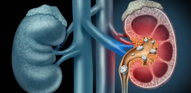 커큐민 부작용-신장결석
