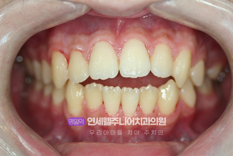 전치부 개방교합으로 어금니를 물어도 위아래 앞니가 서로 닿지 않고 공간이 남아 있는 교정 전 모습