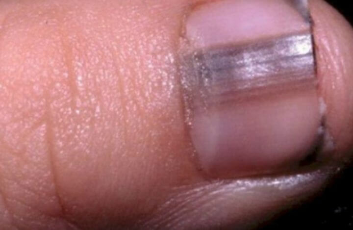 간이 안좋을때 나타나는 증상 손톱