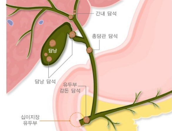 담석증-사진