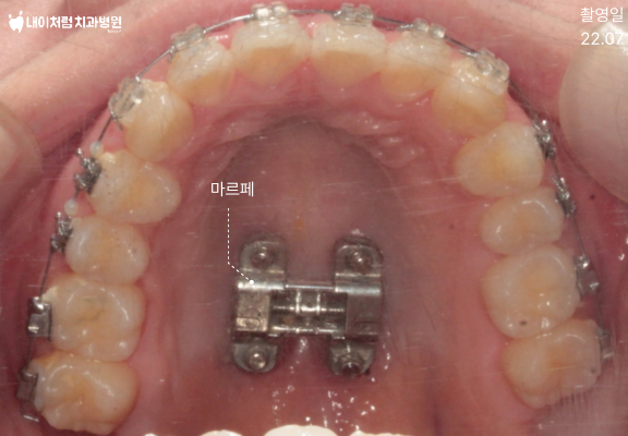 이수역치과 상악 마르페(MARPE) 장치