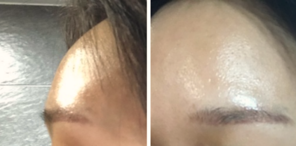 이마 미간 보톡스 후기6