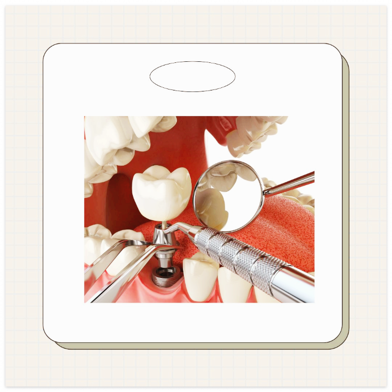 대전 임플란트 지원금