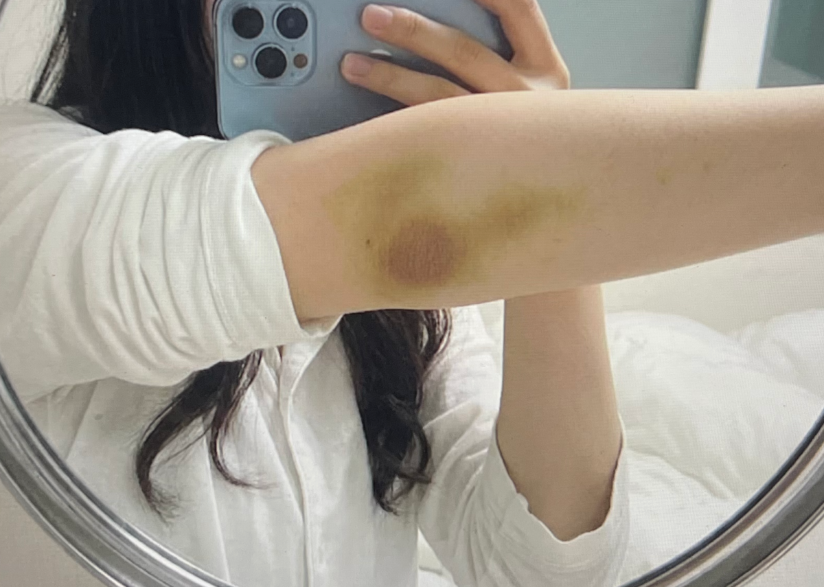 팔꿈치 사용 후기사진