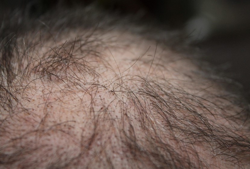 인천한방 탈모치료병원