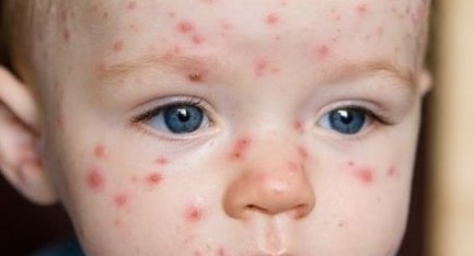 홍역 걸린 아이모습