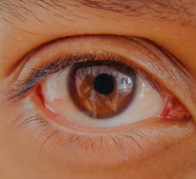 녹내장 치료법 진단 기준 합병증