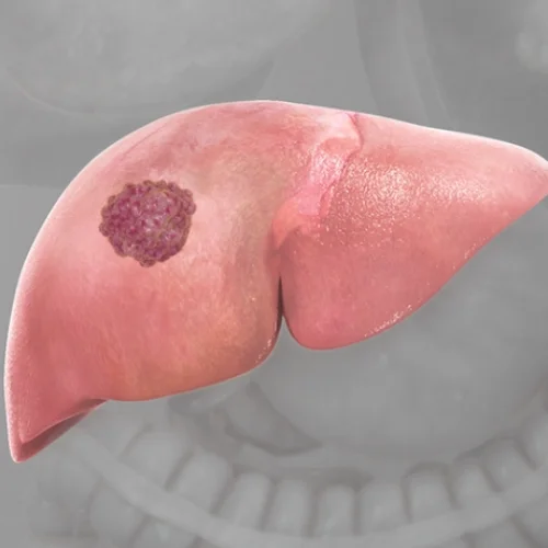 간암이 생기면 나타나는 증상