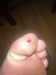 티눈이 생기는 이유