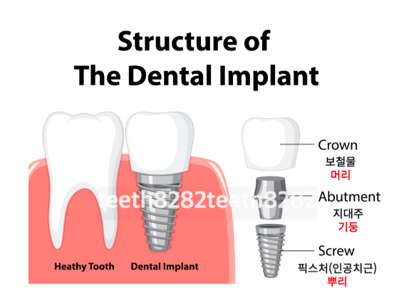 임플란트-1차수술