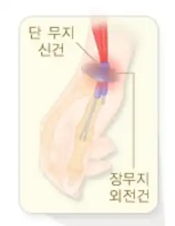 손목건초염-이미지