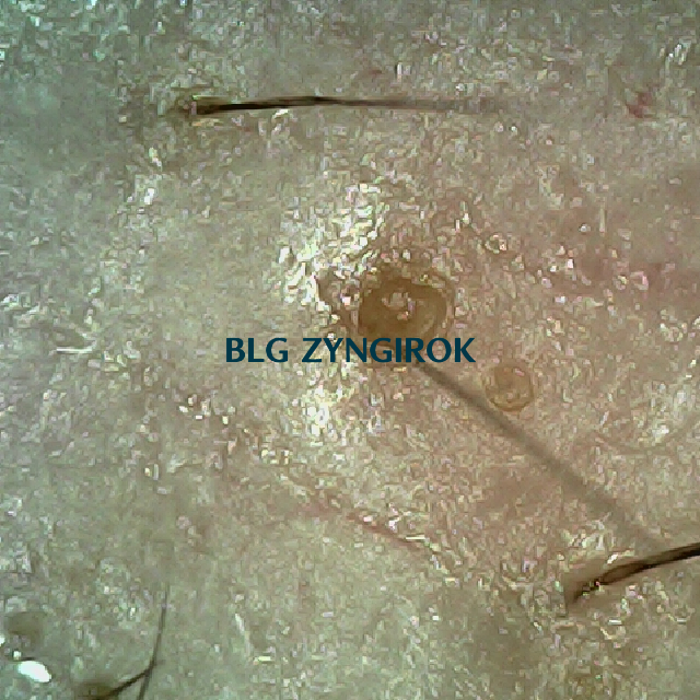 탈모 극복 프로젝트 - 오른쪽 M자 부위 두피 모습이다.