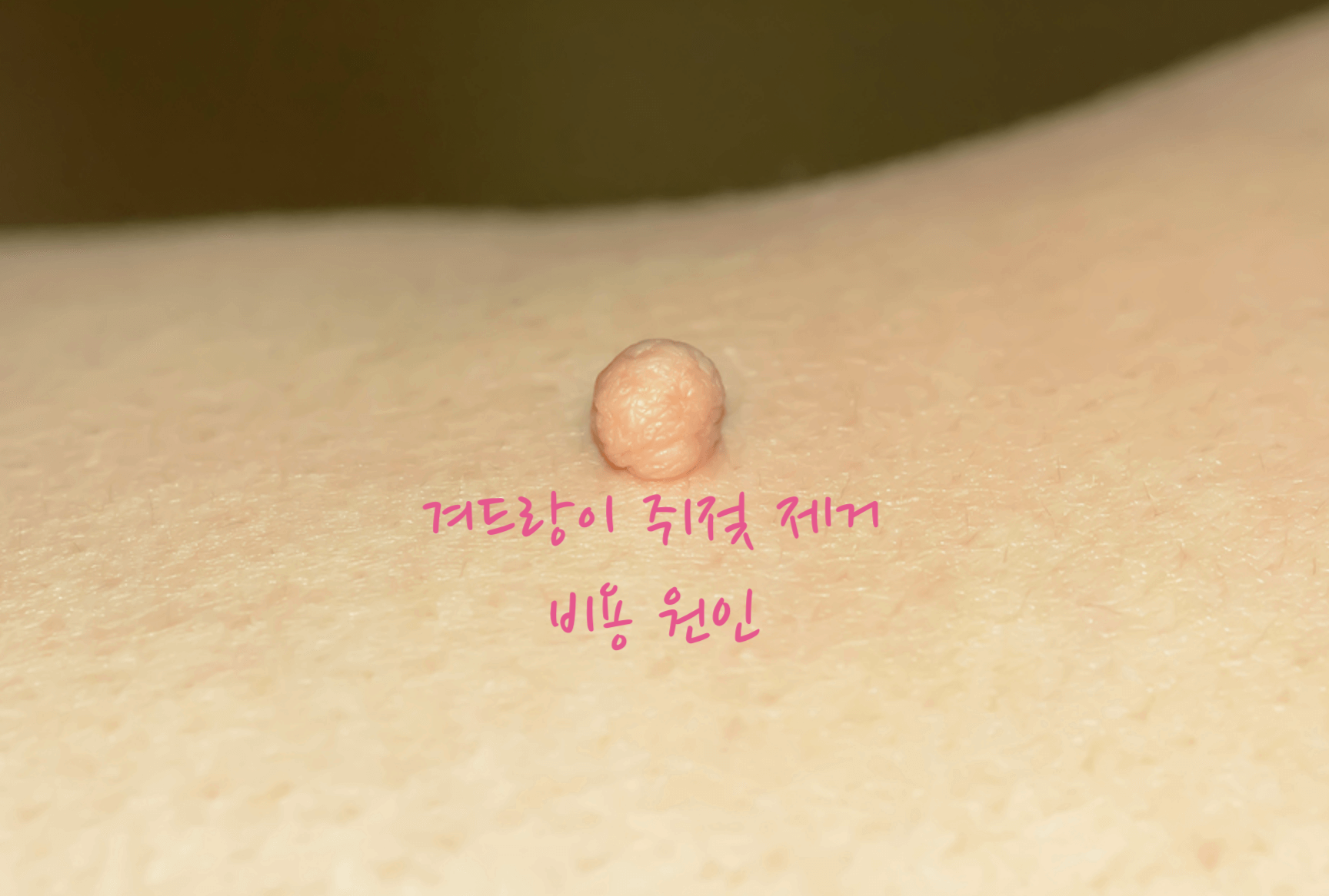 겨드랑이 쥐젖