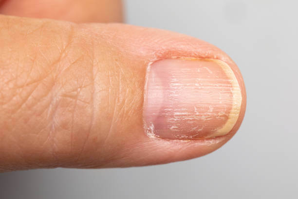 손톱 세로줄과 가로줄 원인이 당뇨와 암일까요? 손톱에 색깔이 변하거나 이상이 생기면 암을 생각할 수 있는데요~ 그 증상들과 관련이 있는지 참고하시기 바랍니다.