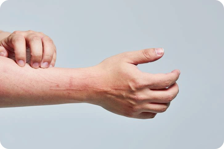 피부-묘기증-증상