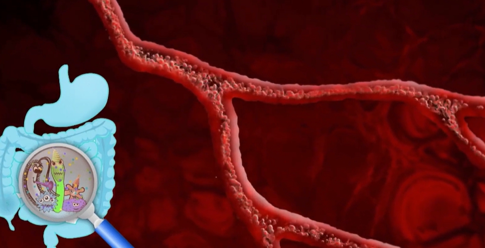 장누수증후군 증상