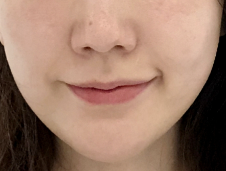 스킨보톡스 후기