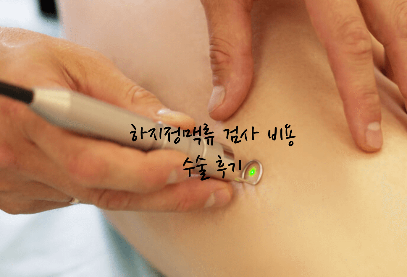하지정맥류