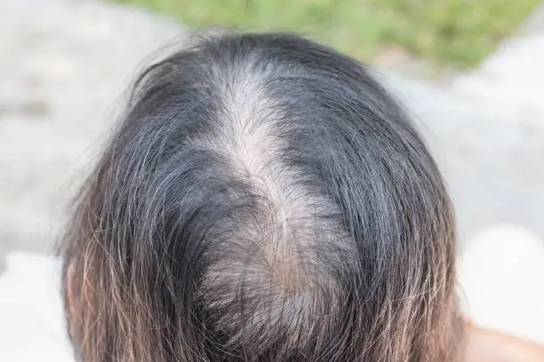 정수리 탈모 치료