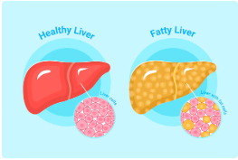간수치 높을 때 증상