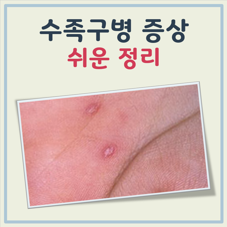 수족구병 증상 대표 이미지