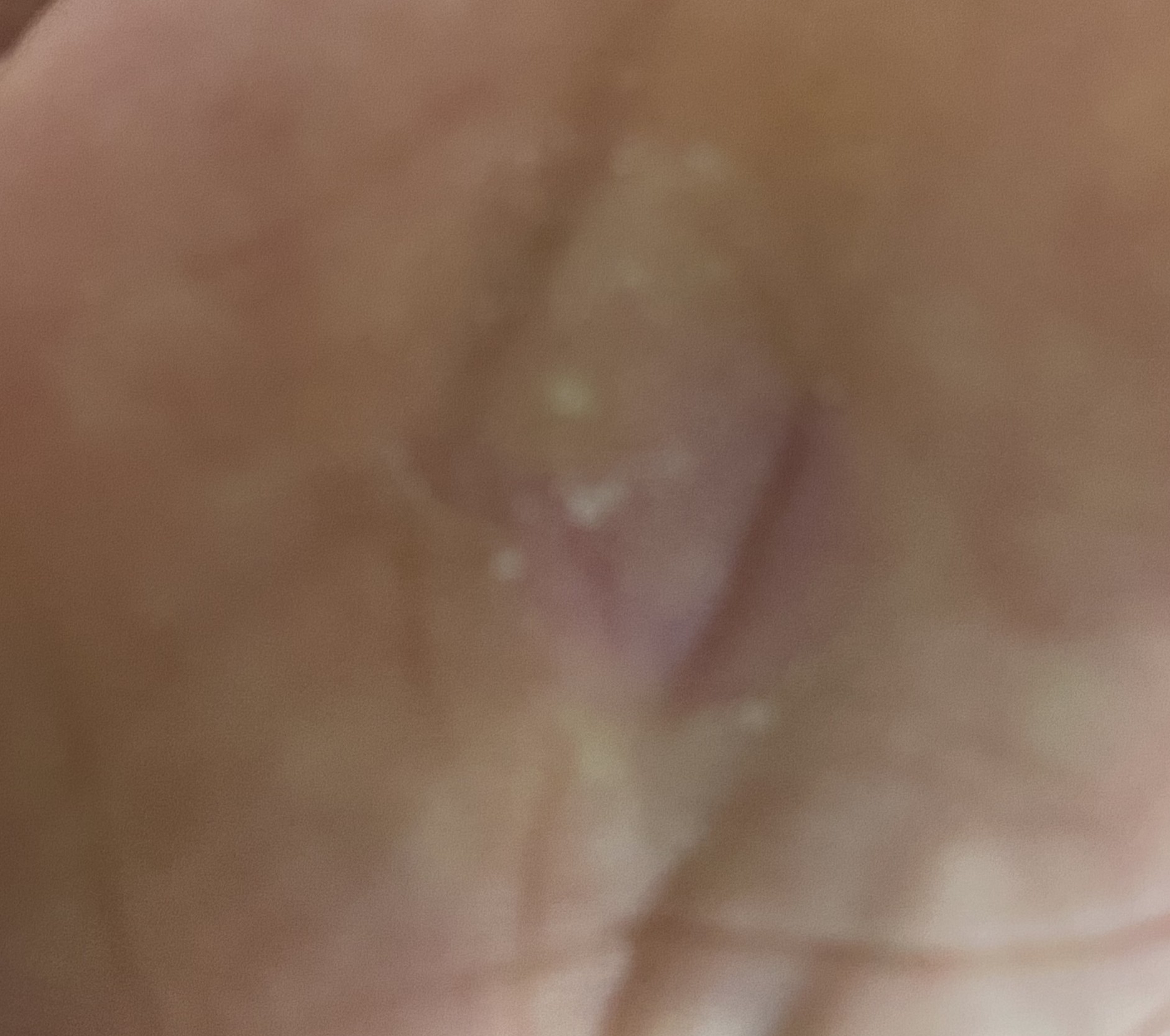 일주일쯤 지난후의 모습이에요. 아직도 티눈이 벗겨진지 모르겠죠.