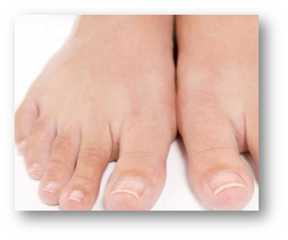 발톱 들렸을 때 2