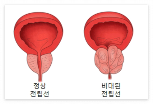 전립선염
