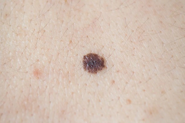 흑색종 치료법과 예후