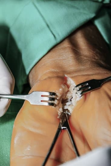 수근관 증후군 수술