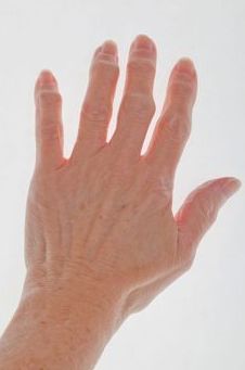 손가락 관절염 증상(사진 : Pinterest)