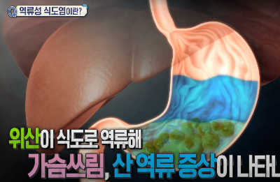 역류성 식도염 증상