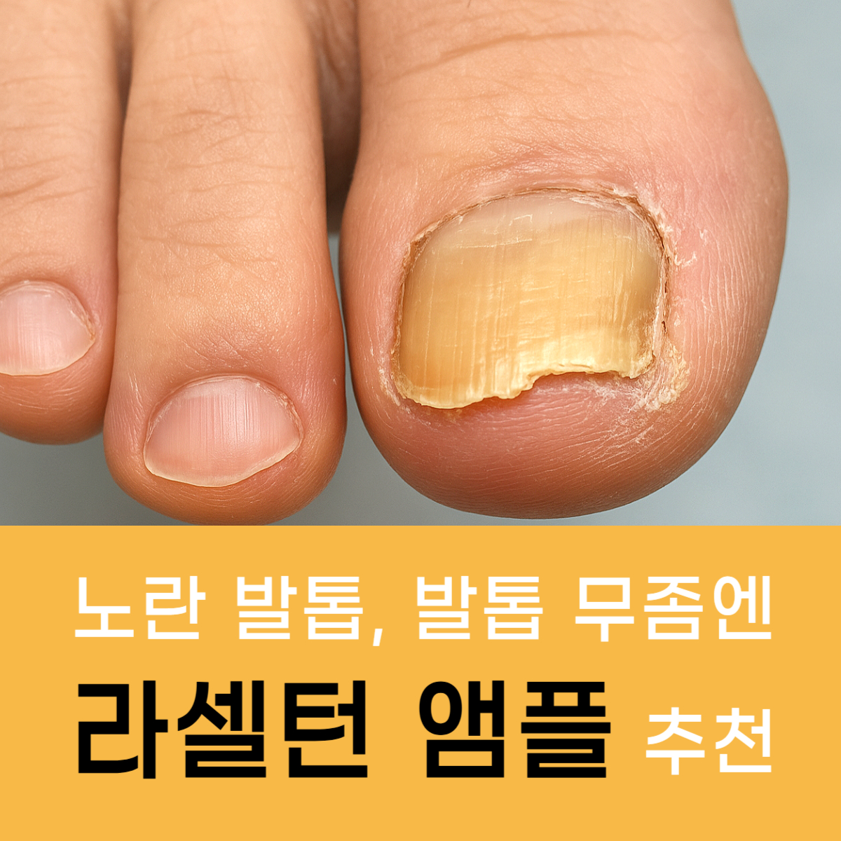발톱 무좀 노란 발톱 없애는 방법 약 추천(내돈내산) 문제성 발톱 클리닉 클리닉 앰플