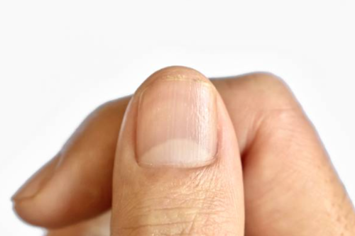 손톱 울퉁불퉁