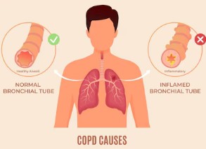 기관지염-증상-4