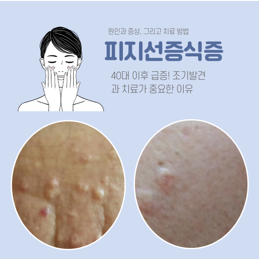피지증식증: 40대 이후 급증! 조기발견과 치료가 중요한 이유