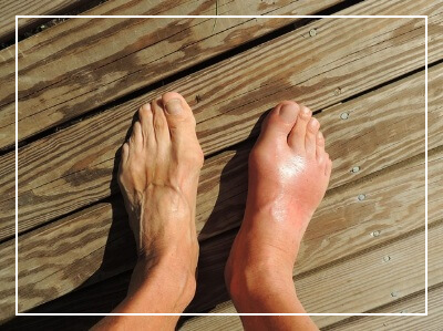 통풍에 해로운 음식