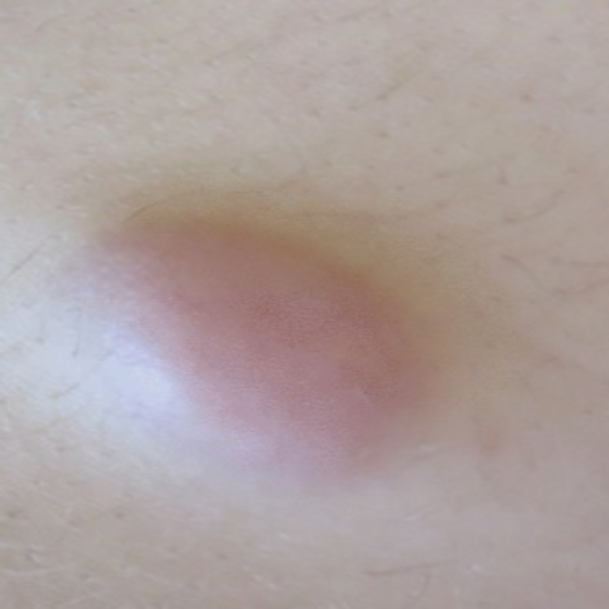 신경섬유종 초기 증상&amp;#44; 혹시 나도? 놓치면 안 되는 신호