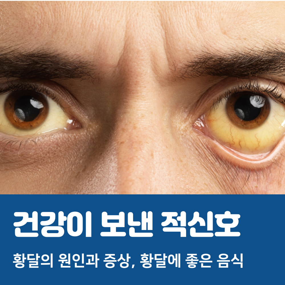황달이 와서 노랗게 변한 눈 흰자 이미지입니다.
황달의 원인과 증상, 황달에 좋은 음식