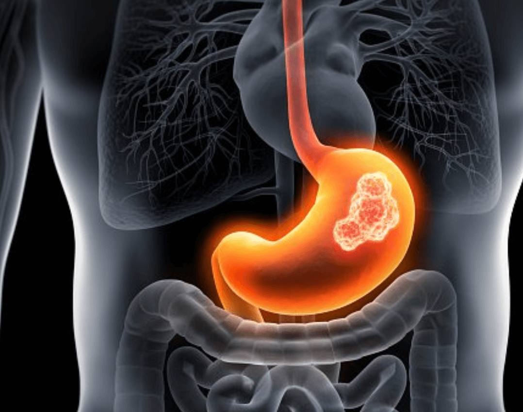 스트레스성 위염 증상 완화방법