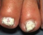 발톱무좀 백색 표재형