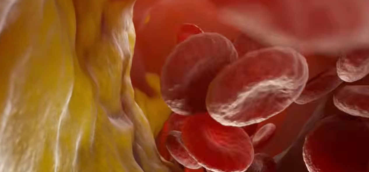 뇌경색 전조증상