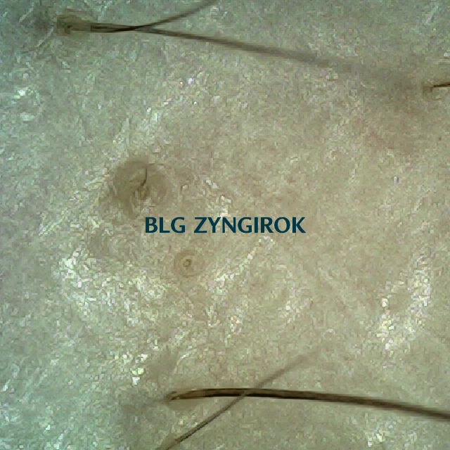 탈모 극복 프로젝트 - 오른쪽 M자 부위 두피 모습이다.