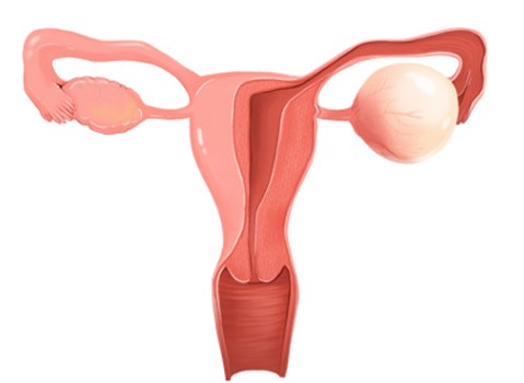 난소 혹 크기 8센치 5센티 증상 | 난소혹 난소암 차이 및 검사 방법
