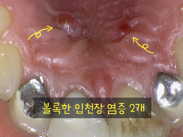 입천장 헐었을 때 면역력 저하 관련 증상과 영양 관리법_1