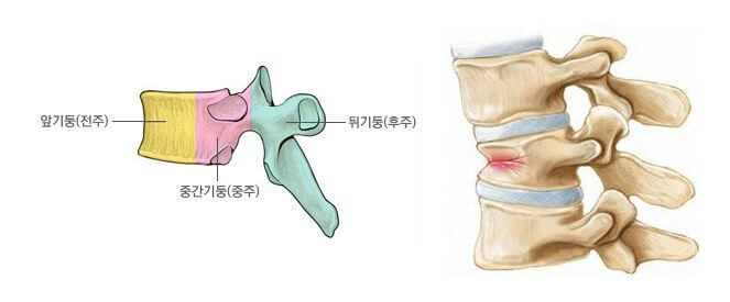 척추압박골절