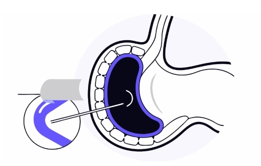 역류성식도염 치료 과정
