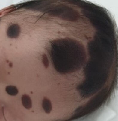 신생아-머리와-이마-주위에-발생한-선천성-거대모반입니다.