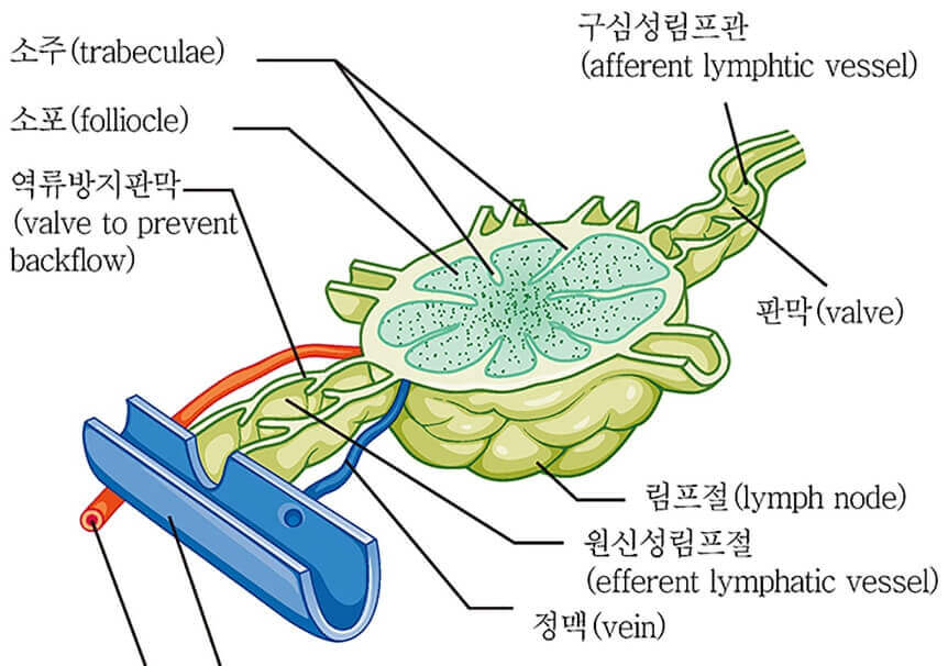 림프종 - 림프절 사진