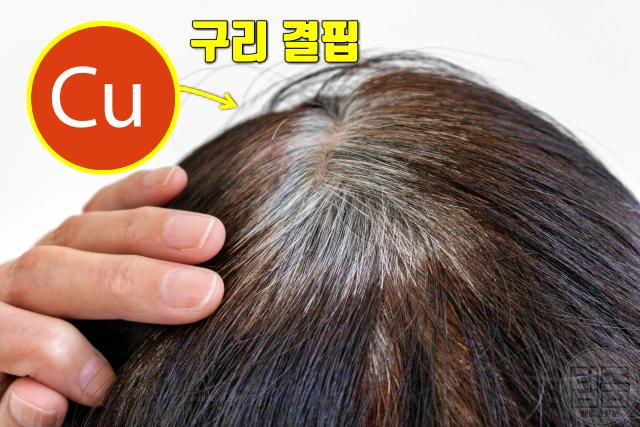필수 비타민 부족 결핍 증상 흰머리